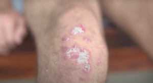 Psoriasis treatment in Ayurveda