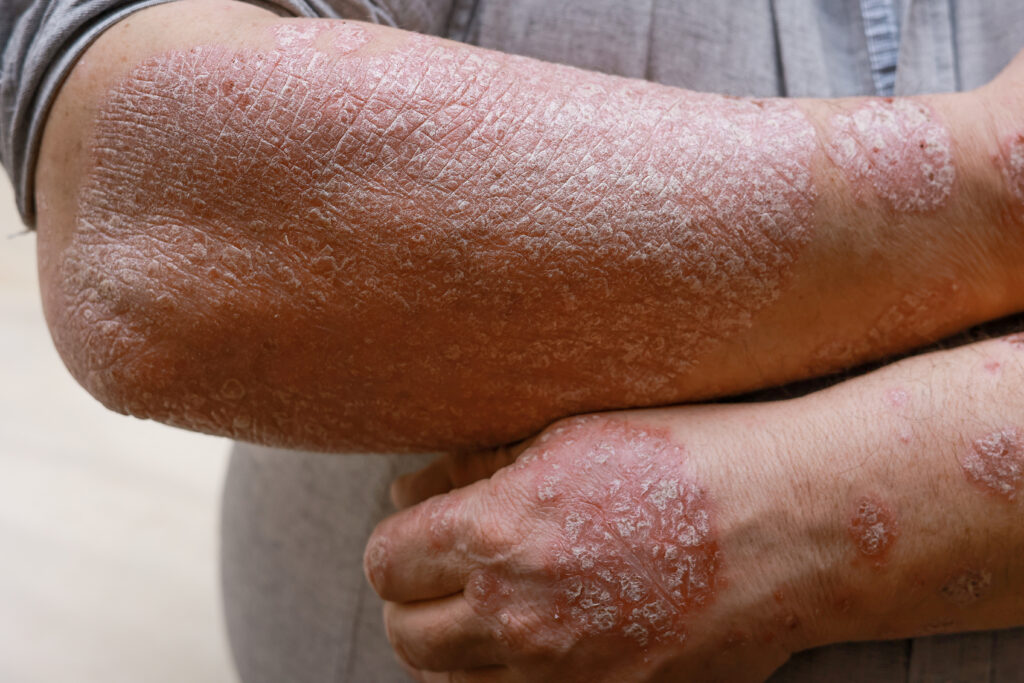 Get ayurveda treatment for Eczema soon to manage the problem and heal it