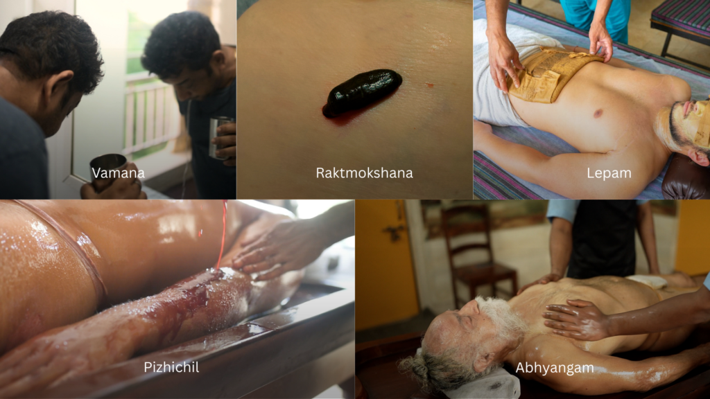 There are many vitiligo ayurvedic treatment at VVAC like Lepam, Vamana, Abhyangam and more