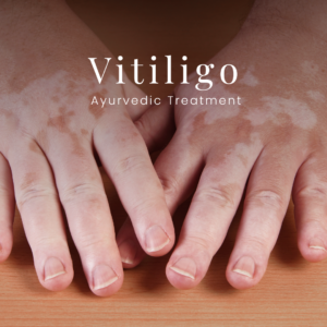 VVAC offers the best Vitiligo Ayurvedic Treatment